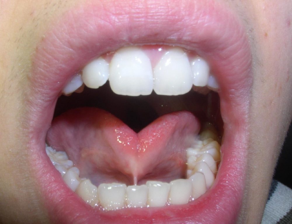 What Does A Tongue Tie Look Like? Dr. Chelsea Pinto Los Angeles