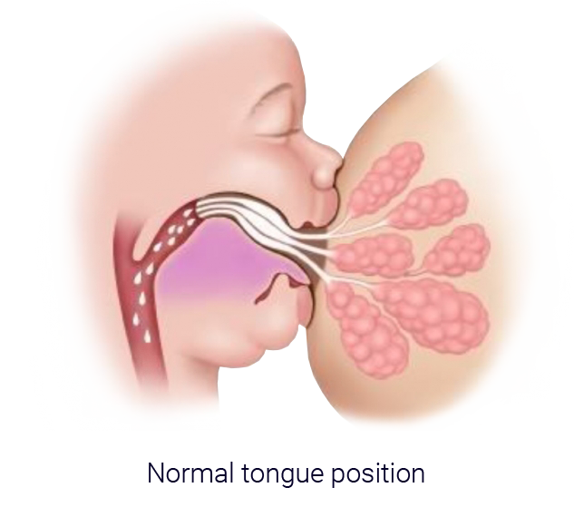 Infant Tongue Tie Treatment
