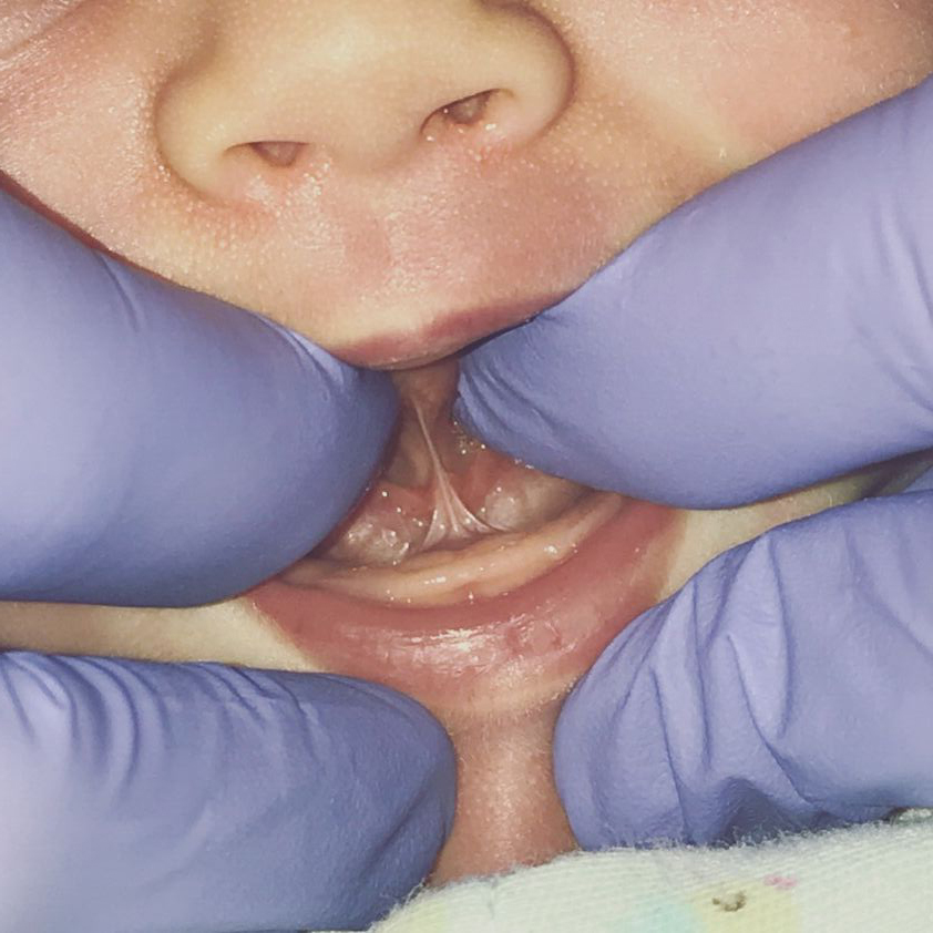 Infant Tongue Tie Treatment